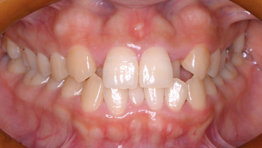 前歯（側切歯）と八重歯（犬歯）が重なった叢生の矯正治療前の歯並び